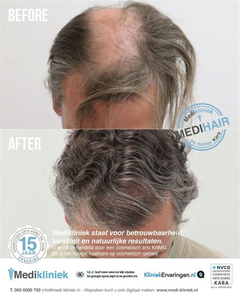 Haartransplantatie Bij Erfstelijke Haaruitval