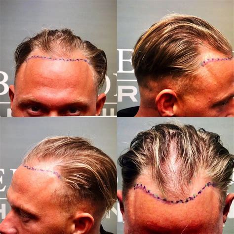 Haartransplantatie En Genetica: Wat Zegt Het Onderzoek?