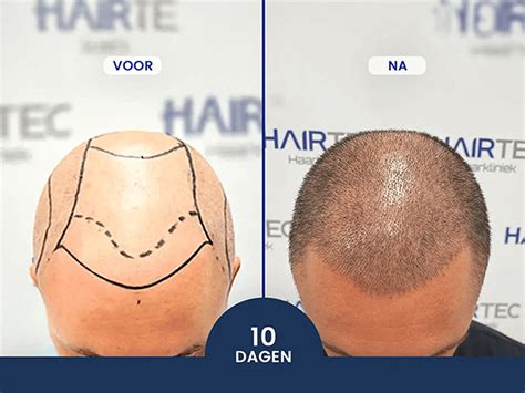 Tips Voor Het Kiezen Van Een Haartransplantatie Methode